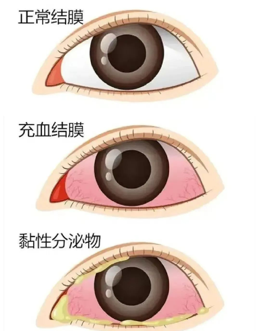 预防“红眼病”，呵护眼健康——海口市山高幼儿园急性结膜炎预防知识宣传活动-图片11