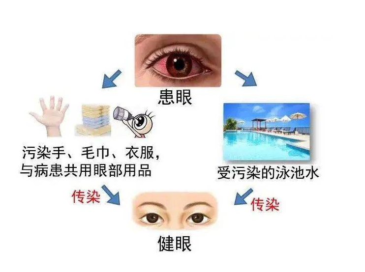预防“红眼病”，呵护眼健康——海口市山高幼儿园急性结膜炎预防知识宣传活动-图片21